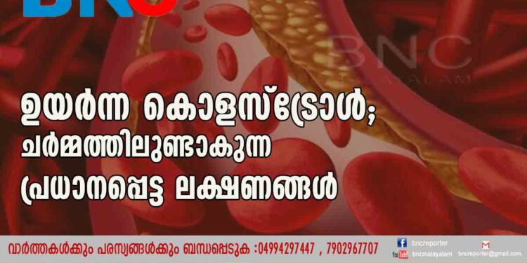 ഉയർന്ന കൊളസ്ട്രോൾ; ചർമ്മത്തിലുണ്ടാകുന്ന പ്രധാനപ്പെട്ട ലക്ഷണങ്ങൾ