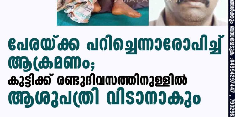 പേരയ്ക്ക പറിച്ചെന്നാരോപിച്ച് ആക്രമണം; കുട്ടിക്ക് രണ്ടുദിവസത്തിനുള്ളിൽ ആശുപത്രി വിടാനാകും