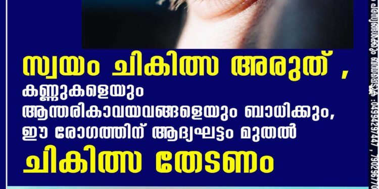 സ്വയം ചികിത്സ അരുത് ,​ കണ്ണുകളെയും ആന്തരികാവയവങ്ങളെയും ബാധിക്കും,​ ഈ രോഗത്തിന് ആദ്യഘട്ടം മുതൽ ചികിത്സ തേടണം