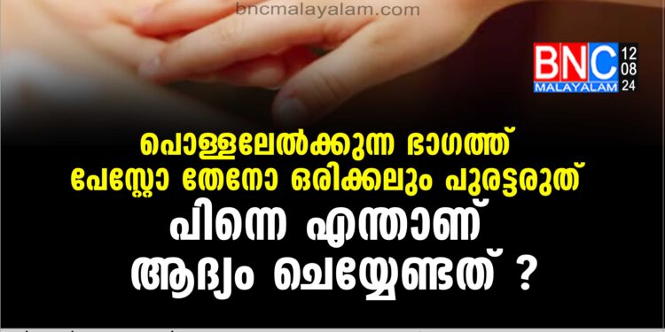 പൊള്ളലേല്‍ക്കുന്ന ഭാഗത്ത് പേസ്റ്റോ തേനോ ഒരിക്കലും പുരട്ടരുത് . എന്താണ് ആദ്യം ചെയ്യേണ്ടത് എന്തൊക്കെ ചെയ്തുകൂടാ