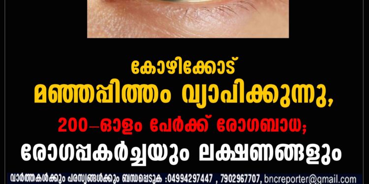 കോഴിക്കോട് മഞ്ഞപ്പിത്തം വ്യാപിക്കുന്നു, 200-ഓളം പേർക്ക് രോ​ഗബാധ